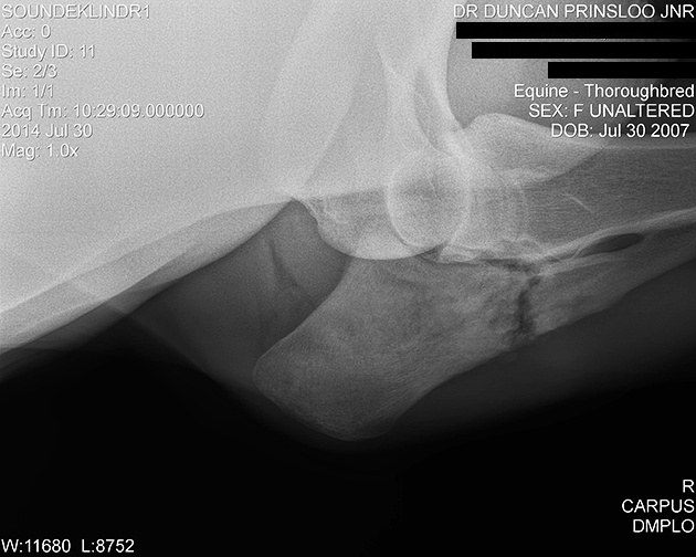 ELBOW FRACTURE 20 Copy